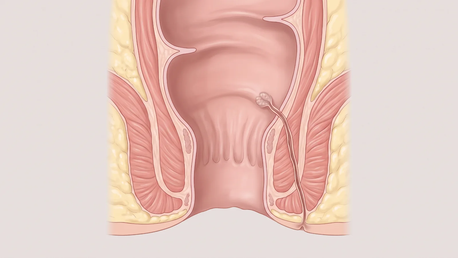 anal fistül nedir - anüs kanalını ve çevre kas halkalarını gösteren sade anatomik kesit çizimi