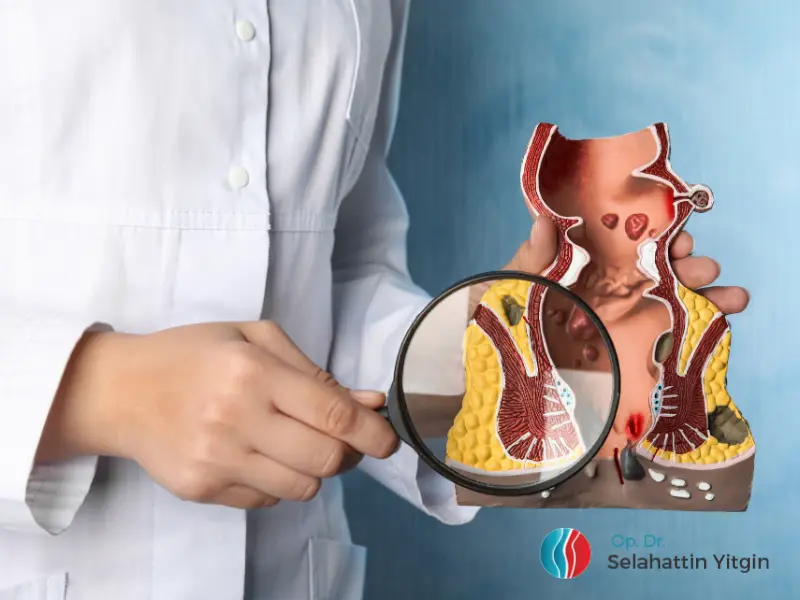 Anal fistül maketini büyüteçle inceleyen doktorun eli. Makat fistülü ve apse oluşumu görselleştirilmiş.